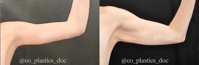Arm Lift result at La Vie Plastic Surgery in Lone Tree, CO