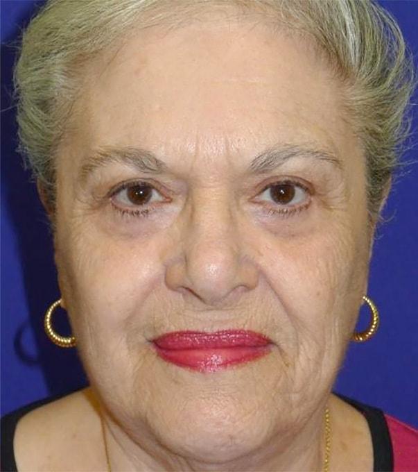 Plastic Surgery Institute of Washington eyelid lift after — North Bethesda, MD