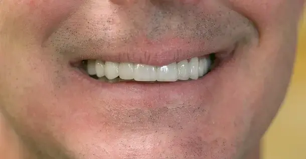 Smile Makeover after at Fifth Avenue Dental Arts in San Diego, CA
