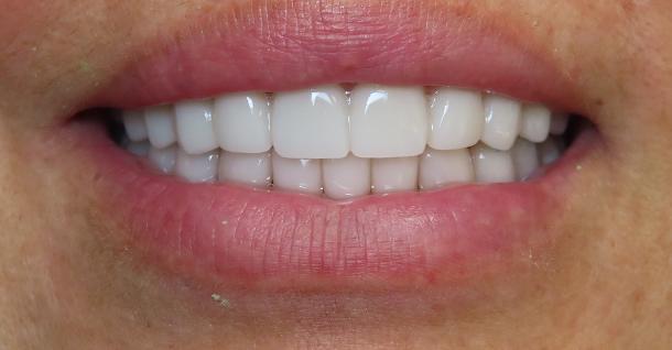 Fifth Avenue Dental Arts veneers after — San Diego, CA