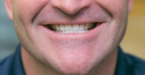 Dental Veneers after at Fifth Avenue Dental Arts in San Diego, CA