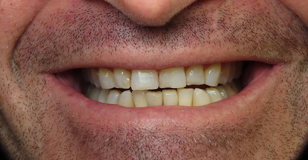 Dental Veneers before at Fifth Avenue Dental Arts in San Diego, CA