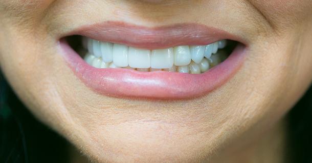 Dental Veneers after at Fifth Avenue Dental Arts in San Diego, CA