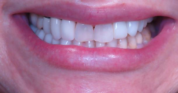 Dental Veneers before at Fifth Avenue Dental Arts in San Diego, CA