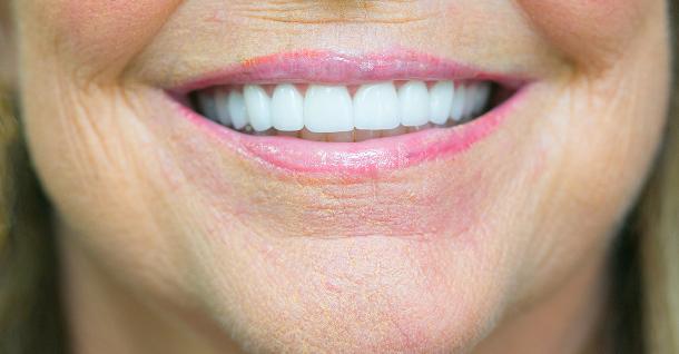 Fifth Avenue Dental Arts smile makeover after — San Diego, CA
