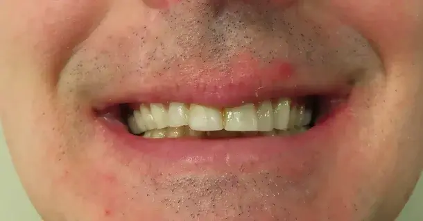 Smile Makeover before at Fifth Avenue Dental Arts in San Diego, CA