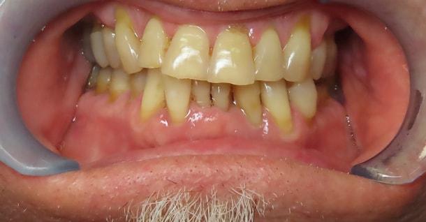Dental Implants before at Fifth Avenue Dental Arts in San Diego, CA