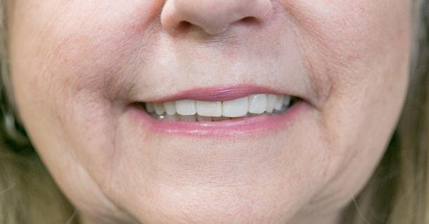 Fifth Avenue Dental Arts dental crowns after — San Diego, CA
