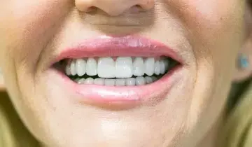 Smile Makeover after at Fifth Avenue Dental Arts in San Diego, CA
