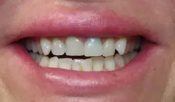 Smile Makeover before at Fifth Avenue Dental Arts in San Diego, CA