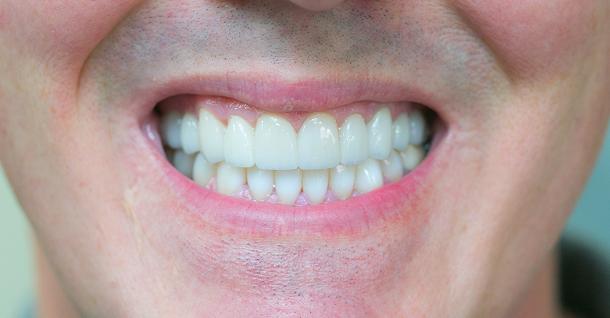 Fifth Avenue Dental Arts smile makeover after — San Diego, CA