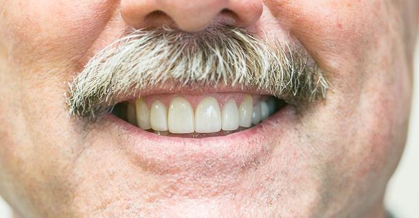 Fifth Avenue Dental Arts veneers after — San Diego, CA