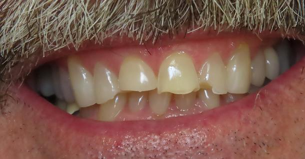 Dental Veneers before at Fifth Avenue Dental Arts in San Diego, CA
