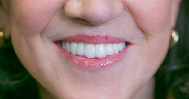 Fifth Avenue Dental Arts veneers after — San Diego, CA