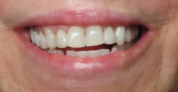 Dental Veneers before at Fifth Avenue Dental Arts in San Diego, CA