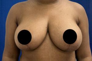 Breast Reduction after at Le Spa Plastic Surgery in Oakland Park, FL