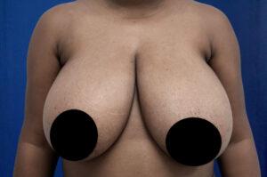 Breast Reduction before at Le Spa Plastic Surgery in Oakland Park, FL