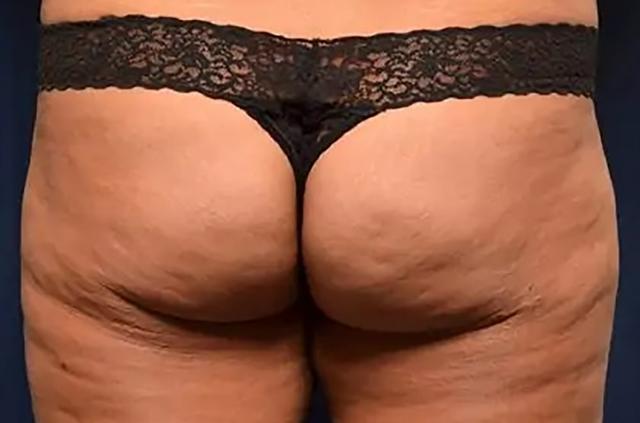 Brazilian Butt Lift before at Le Spa Plastic Surgery in Oakland Park, FL