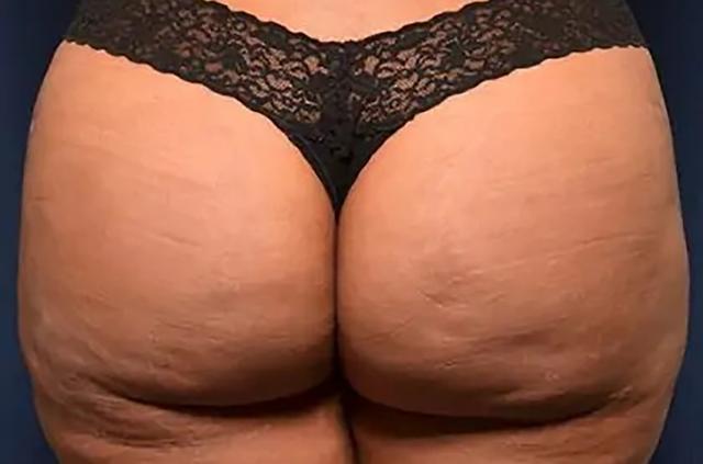 Brazilian Butt Lift after at Le Spa Plastic Surgery in Oakland Park, FL