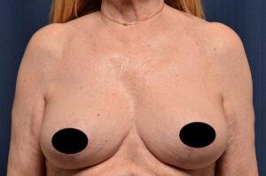 Breast Lift after at Le Spa Plastic Surgery in Oakland Park, FL