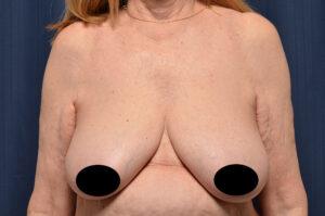 Breast Lift before at Le Spa Plastic Surgery in Oakland Park, FL