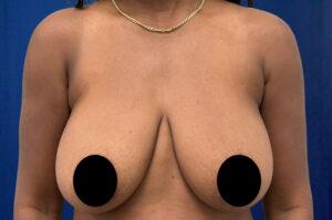 Breast Lift before at Le Spa Plastic Surgery in Oakland Park, FL