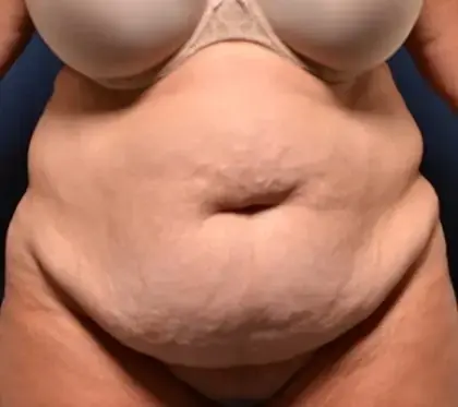 Mini Tummy Tuck before at Le Spa Plastic Surgery in Oakland Park, FL
