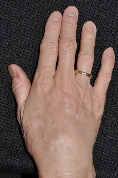 Le Spa Plastic Surgery fat transfer after — Oakland Park, FL