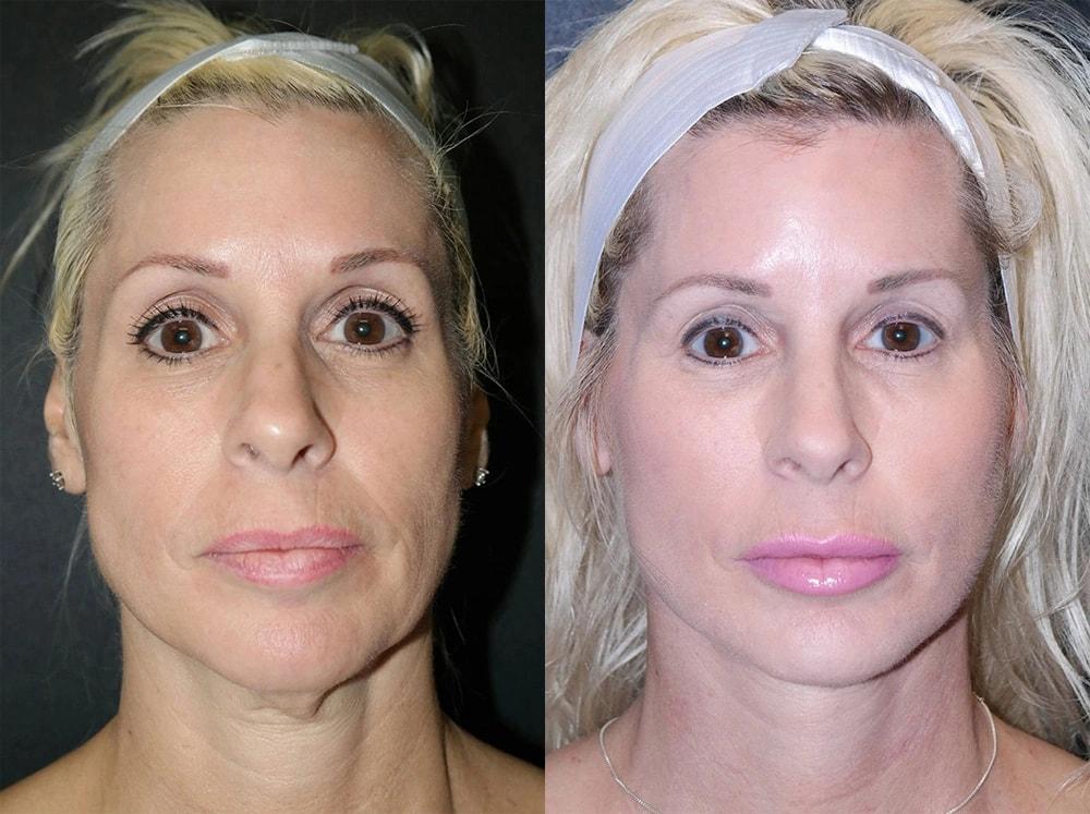 Semira Bayati, MD, Plastic Surgery Boutique facelift result — Newport Beach, CA