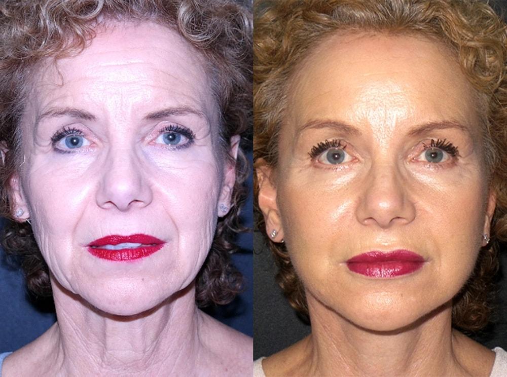 Semira Bayati, MD, Plastic Surgery Boutique facelift result — Newport Beach, CA