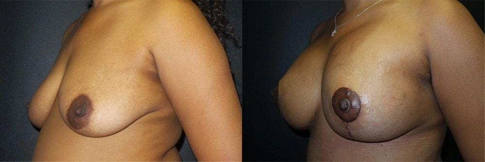 Semira Bayati, MD, Plastic Surgery Boutique breast lift result — Newport Beach, CA
