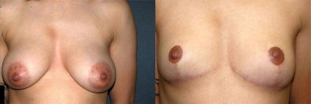 Semira Bayati, MD, Plastic Surgery Boutique breast lift result — Newport Beach, CA