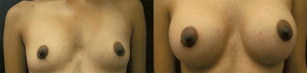 Semira Bayati, MD, Plastic Surgery Boutique breast augmentation result — Newport Beach, CA
