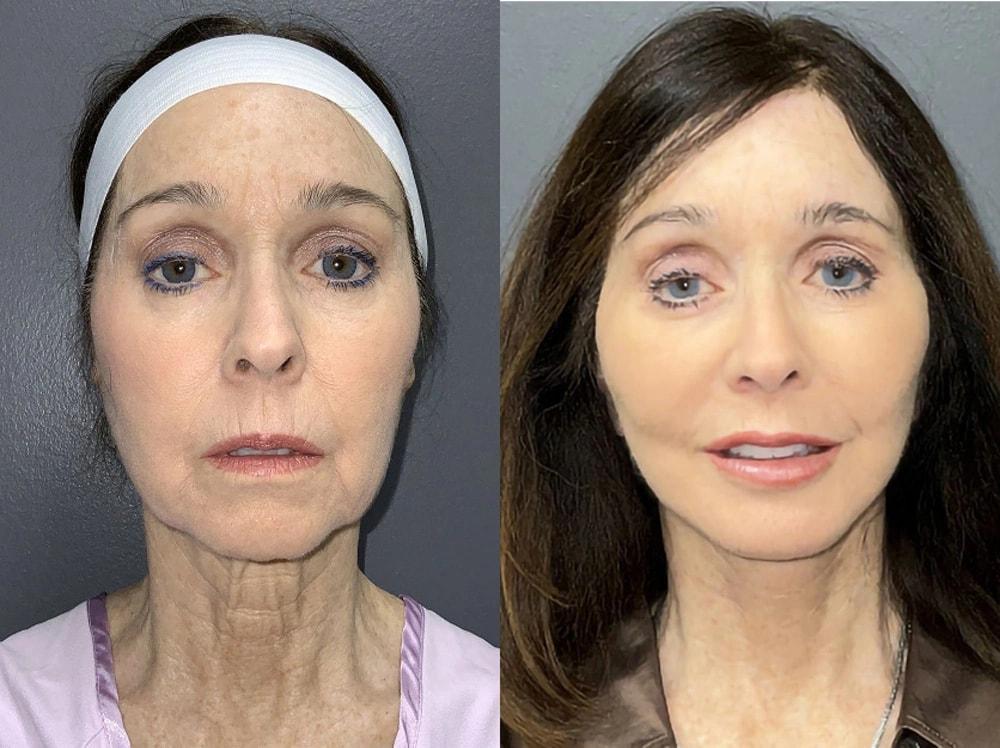 Semira Bayati, MD, Plastic Surgery Boutique facelift result — Newport Beach, CA