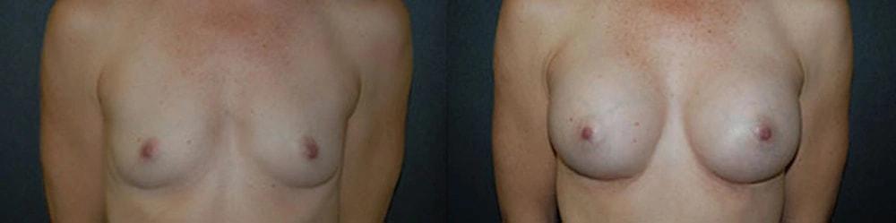 Semira Bayati, MD, Plastic Surgery Boutique breast augmentation result — Newport Beach, CA