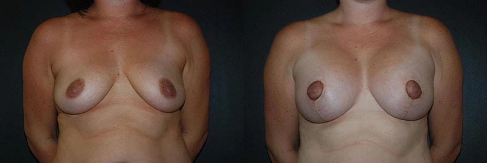 Semira Bayati, MD, Plastic Surgery Boutique breast lift result — Newport Beach, CA