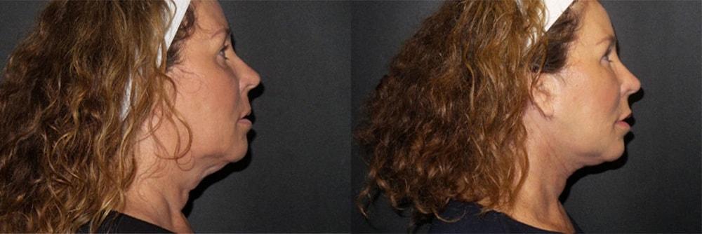 Semira Bayati, MD, Plastic Surgery Boutique neck lift result — Newport Beach, CA