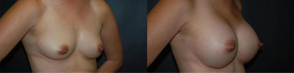Semira Bayati, MD, Plastic Surgery Boutique breast augmentation result — Newport Beach, CA