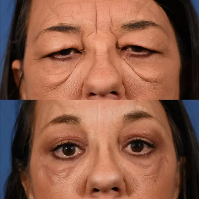 Blepharoplasty result at Jesse E Smith, MD, FACS in Fort Worth, TX
