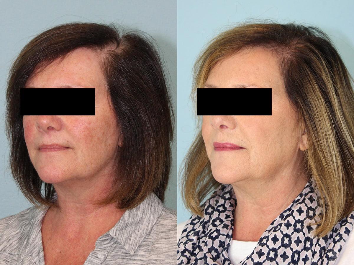 Jesse E Smith, MD, FACS facelift result — Fort Worth, TX