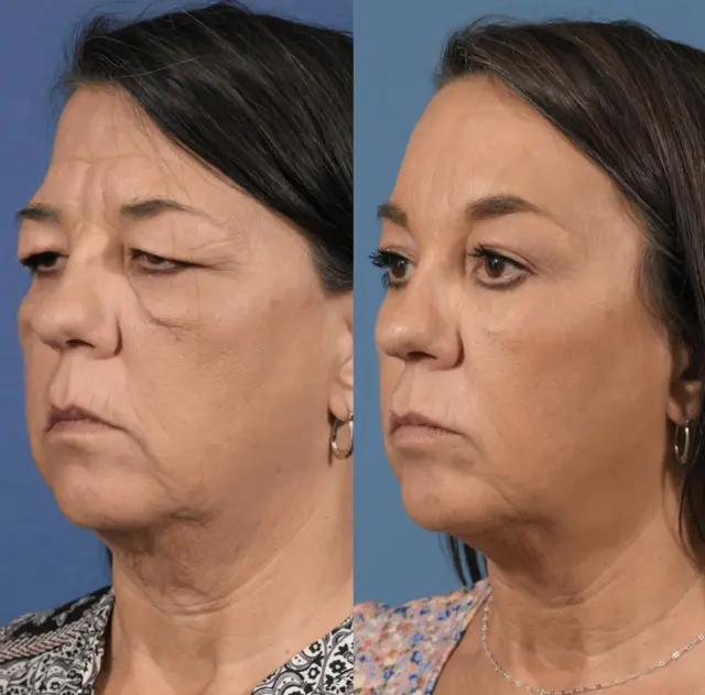 Blepharoplasty result at Jesse E Smith, MD, FACS in Fort Worth, TX