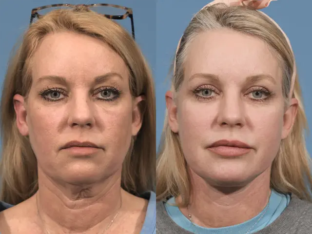 Neck Lift result at Jesse E Smith, MD, FACS in Fort Worth, TX