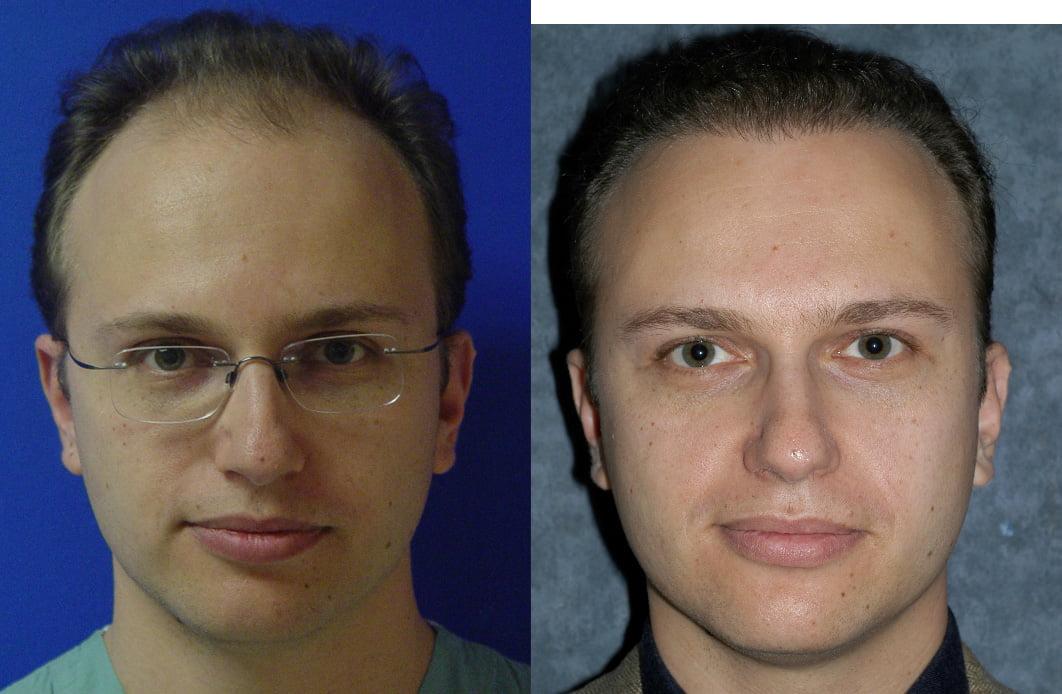 Jesse E Smith, MD, FACS hair restoration result — Fort Worth, TX