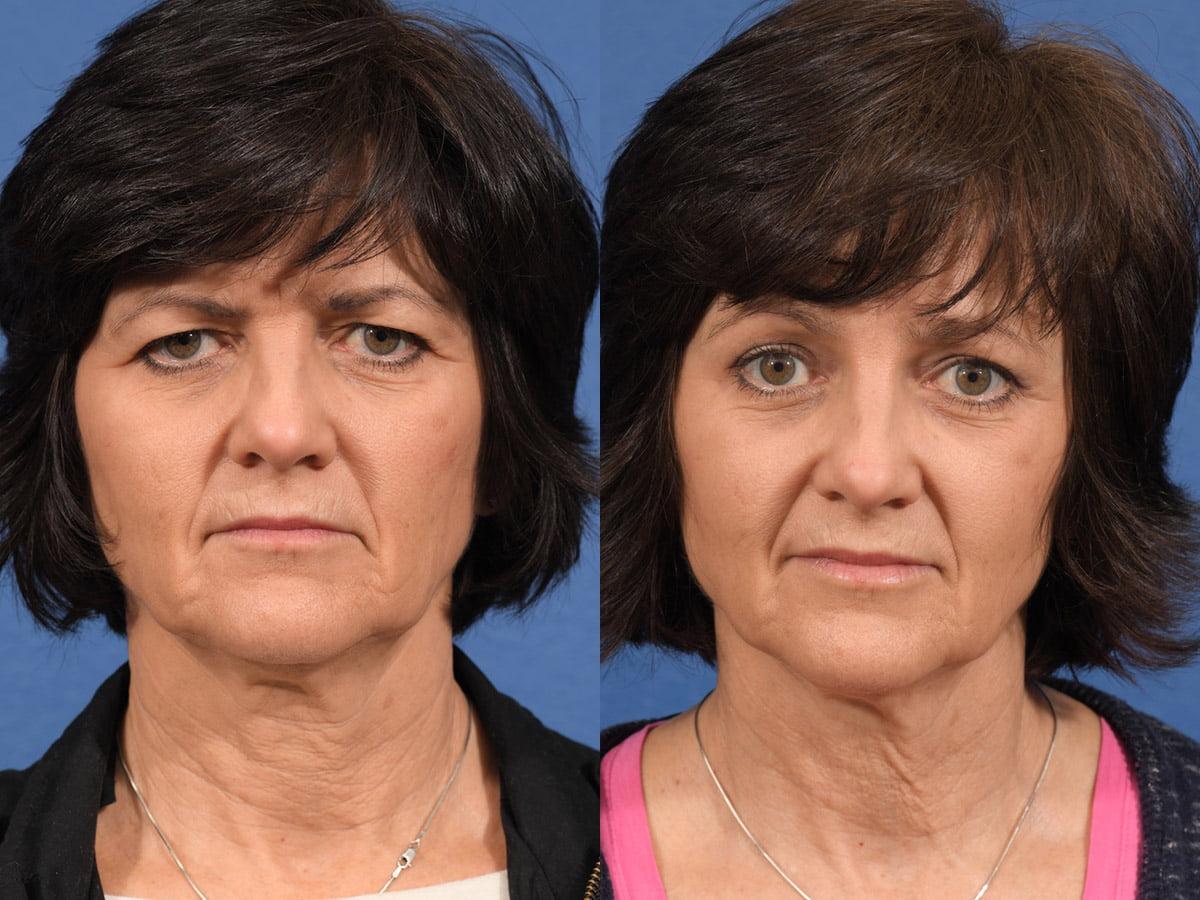 Jesse E Smith, MD, FACS blepharoplasty result — Fort Worth, TX