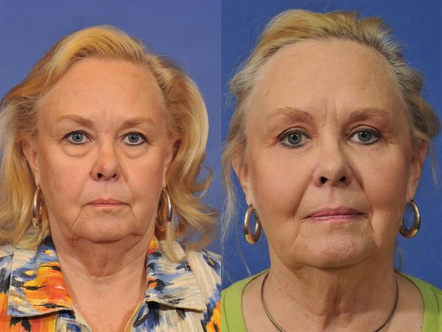 Blepharoplasty result at Jesse E Smith, MD, FACS in Fort Worth, TX