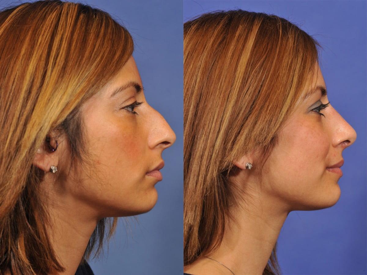 Jesse E Smith, MD, FACS rhinoplasty result — Fort Worth, TX