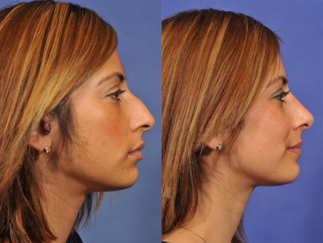 Liquid Rhinoplasty result at Jesse E Smith, MD, FACS in Fort Worth, TX