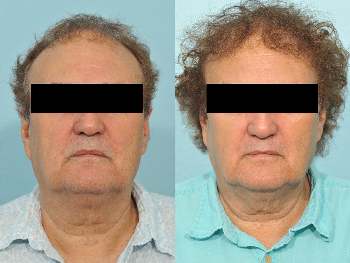 Jesse E Smith, MD, FACS hair restoration result — Fort Worth, TX