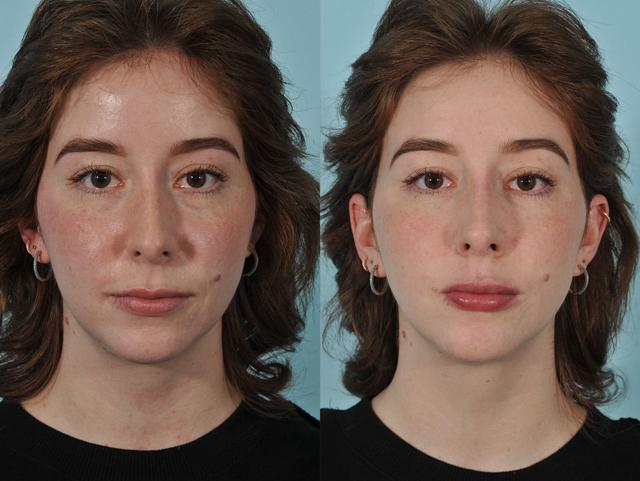 Liquid Rhinoplasty result at Jesse E Smith, MD, FACS in Fort Worth, TX