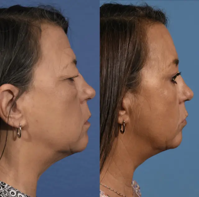 Blepharoplasty result at Jesse E Smith, MD, FACS in Fort Worth, TX